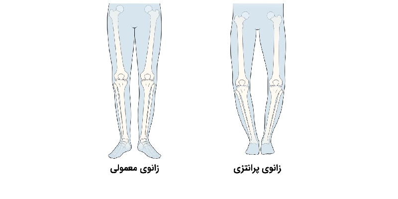 پای پرانتزی در اصلاح لاتین از آن به عنوان ژنوواروم یاد می شود؛ ژنو به معنای زانو واروم به معنای خم شدن به سمت بیرون است پس با این معنی عارضه پای پرانتزی را می توان اینگونه تعریف کرد عارضه ای که در آن زانو ها از حالت طبیعی خارج می شود و پاها به سمت بیرون خم می شوند. در افرادی که پای پرانتزی دارند، استخوان درشت نی (ساق پا)، و استخوان ران (فیمور) دارای انحنا و خمیدگی هستند. پای پرانتزی میتواند باعث درد در ناحیه زانو و ایجاد محدودیتهای حرکتی شود. برخی افراد ممکن است با شرایط پای پرانتزی به دنیا آمده و سایر افراد به خاطر آسیبدیدگی ممکن است به این وضعیت دچار گردند. همچنین این شرایط میتواند با چاقی یا استفاده بیش از حد از مفاصل زانو تشدید شده و در ادامه به یک مشکل جدی برای فرد تبدیل گردد. معمولا با رسیدن به این مرحله درمان به سختی امکانپذیر خواهد بود. درمان پای پرانتزی درمان پای پرانتزی در بزرگساالن بدون جراحی از بهترین و موثرین روش هایی است که در اصالح فرم زانو بسیار تاثیرگذار است. همان طور که می دانیم روش های زیادی برای درمان این عارضه طراحی شده اند که در این میان ورزش های مخصوص پای پرانتزی یکی از این روش ها هستند که با تاثیری که در تقویت عضالت پا و زانو دارد باعث اصالح فرم زانو ها می شود. تمام فعالیت ها برای تقویت عضالت بیرونی پا و کشش عضالت داخلی پا می باشد. چند مورد از ورزش هایی که می توان به آنها اشاره کرد در زیر آمده است: تقویت زانوها با حرکات یوگا تعداد زیادی از تمرینات و حرکات یوگا میتواند به افزایش قدرت، انعطاف پذیری و پایداری زانوهای شما کمک کنند. یوگا یک روش بسیار موثر برای درمان مشکالت زانو است به ویژه اگر در کنار حرکات یوگا از فیزیوتراپی نیز استفاده شود. انجام دادن حرکات پیالتس شما میتوانید از حرکات پیالتس برای تقویت زانوهای خود، رفع گرفتگی آنها و بهبود توانایی حرکات مفاصل زانوی خود استفاده کنید. برخی دیگراز این تمرینات که می توان به صورت عملی انجام داد به شرح زیر میباشند: نوشتن حروف الفبا با انگشتان پا روی یک صفحه فرضی انجام دادن حرکات اسکات در امتداد دیوار حرکت دادن پا به سمت عقب در حالت ایستاده بالا آوردن پاها حرکت قرار دادن پا روی جعبه یا پله حرکت پل باسن دایره کشیدن با توپ (قرار دادن توپ نرم بین دو زانو) حرکت نشست کامل با وزن بدن حرکت اسکات کامل با کمکگرفتن از میز حرکت راه رفتن با کش به صورت ایکس حرکت چرخش مفصل ران در حالت نیمه نشسته ضمن آنکه موارد زیر در کنار ورزش های بالا بسیار مورد اهمیت می باشند: پوشیدن کفش مخصوص دویدن برای محافظت از زانوها پوشیدن کفش مخصوص دویدن میتواند به رفع فشار از روی زانوها و مچ پاها کمک کند . رژیم غذایی سالم برای محافظت و تقویت مفاصل و استخوانها شما باید علاوه بر انجام دادن تمرینات ورزشی ایمن با مصرف مواد غذایی سالم و مقوی از استخوانهای زانوی خود و بافتهای اطراف آن محافظت کنید کاهش وزن و بهبود سلامت استخوانهای زانو چاقی و اضافه وزن باعث میشوند که فشار زیادی به زانوهای شما وارد شود و حالت پرانتزی آنها بدتر گردد. بازگشت به صفحه علم ورزش یاریزان | پای پرانتزی بزرگسالان با ورزش کردن قابل درمان است علی شعبانی فرد / کارشناس حرکات اصلاحی